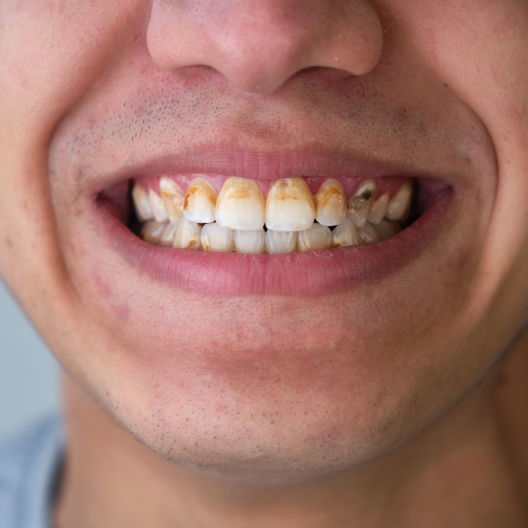 Dente com ranhura